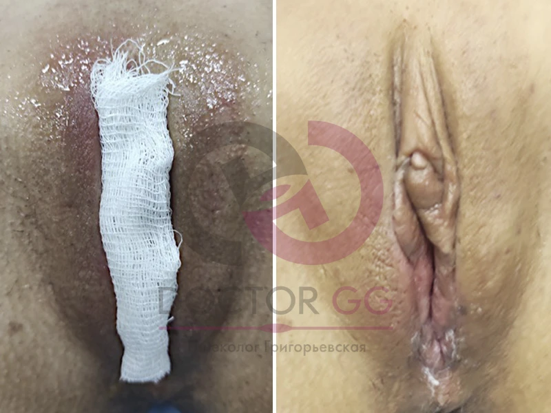 Интимное отбеливание (До и После)