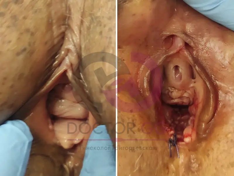 Вагинопластика (До и После)