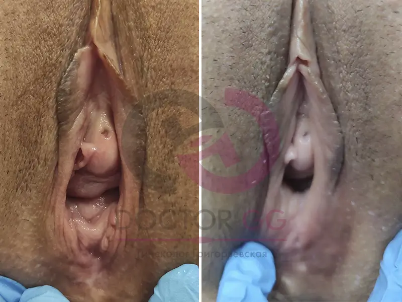 Вагинопластика (До и После)