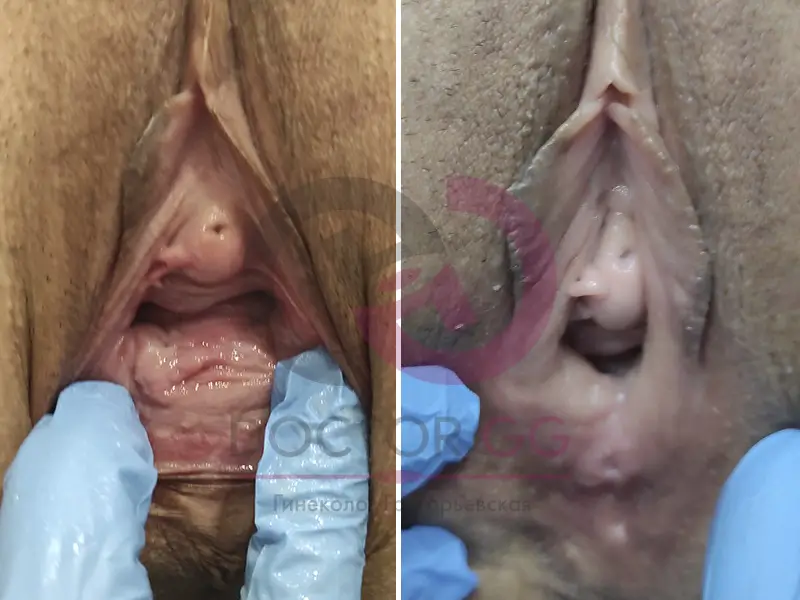 Вагинопластика (До и После)