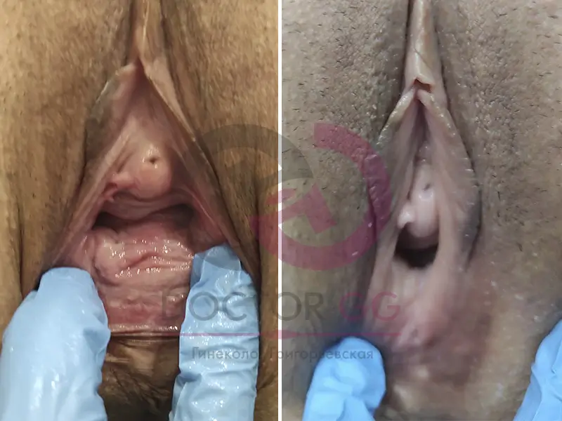 Вагинопластика (До и После)