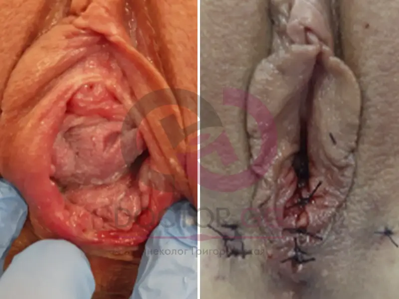 Вагинопластика (До и После)