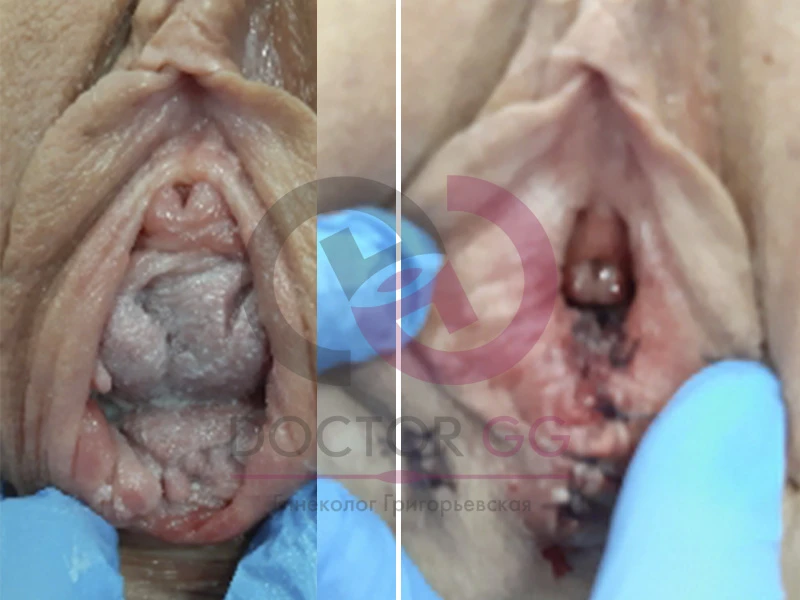 Нитевой лифтинг (До и После)