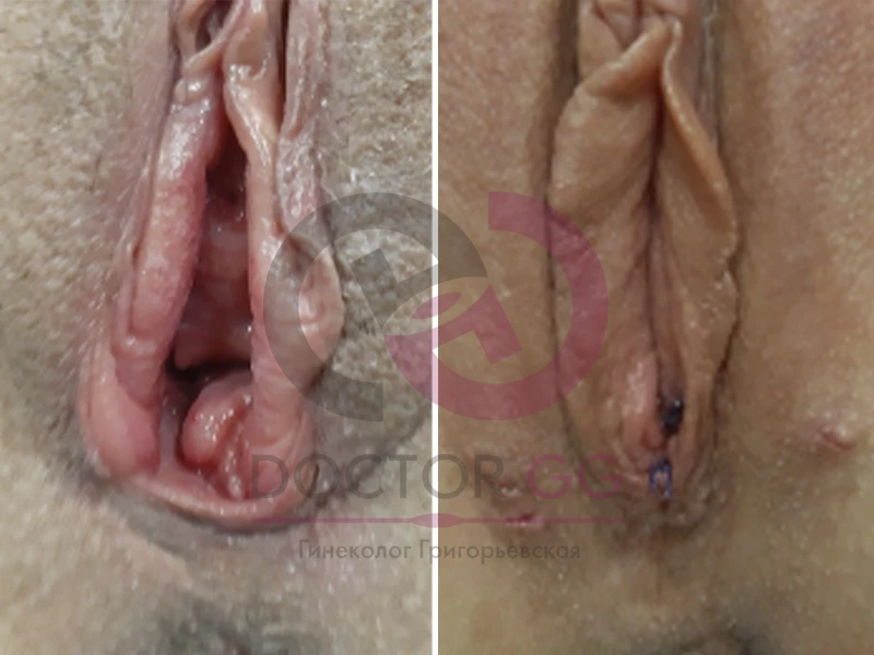 Нитевой лифтинг (До и После)