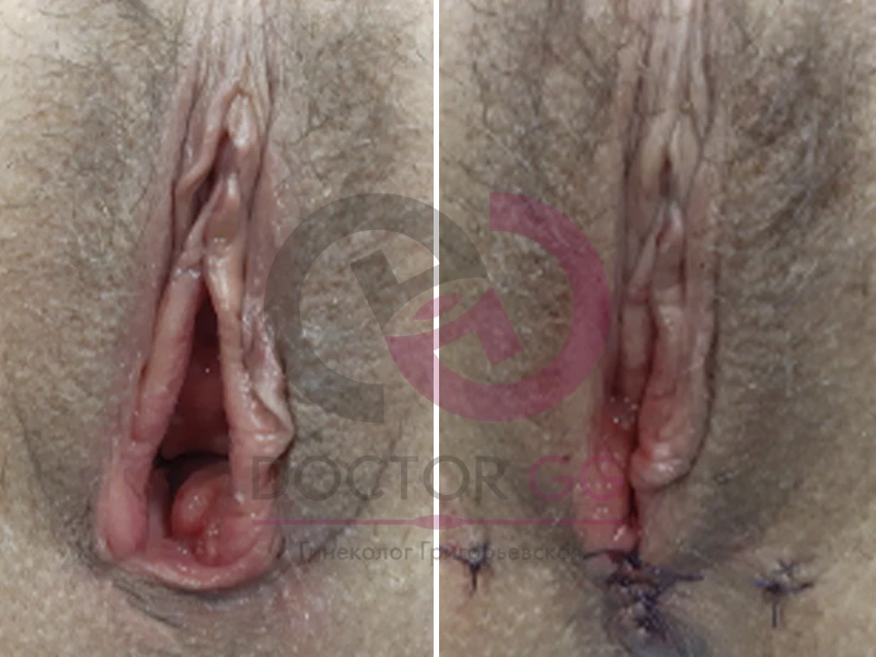 Нитевой лифтинг (До и После)