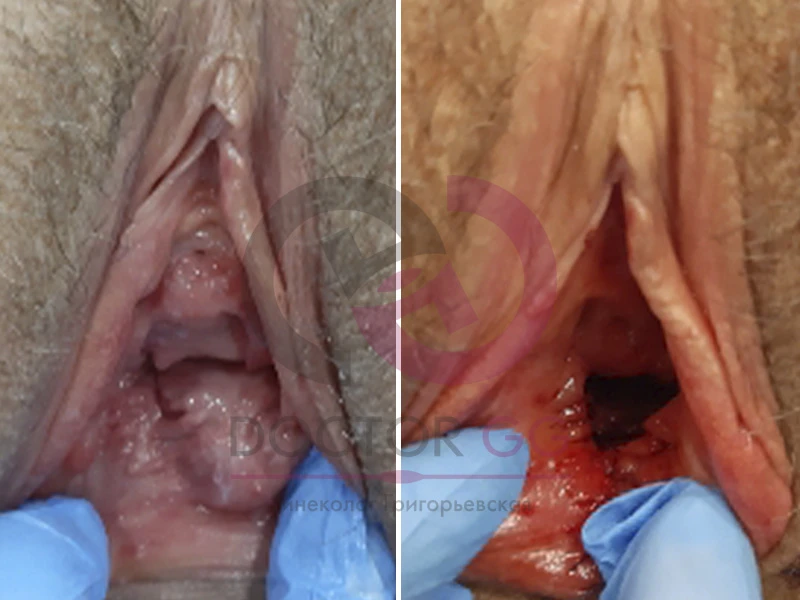 Нитевой лифтинг (До и После)