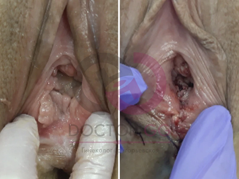 Нитевой лифтинг (До и После)