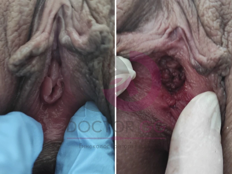 Восстановление девственности (До и После)