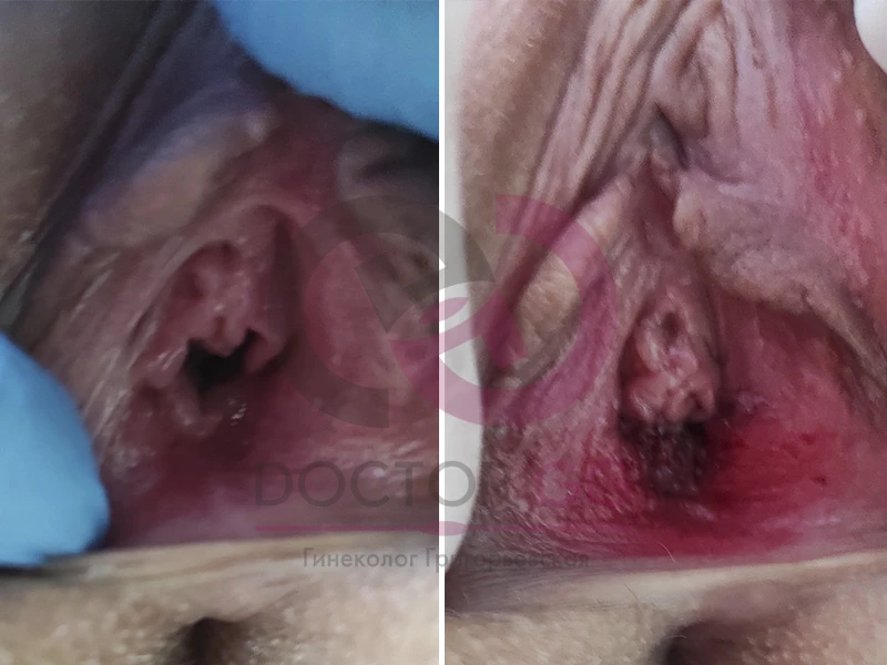 Восстановление девственности (До и После)